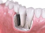 Имплантация зубов в «Первый Доктор» — верное решение!