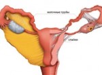 Непроходимость маточных труб. Симптомы