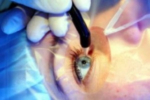 Лазерная коррекция зрения и лечение катаракты