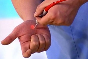 Удаляем бородавки при помощи лазера
