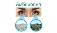 Лечение зрительной амблиопии