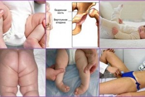 Дисплазия тазобедренных суставов у новорожденных